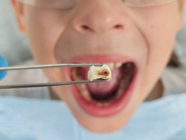 Best Emergency Dentist for Knocked-Out Tooth in Voorheesville, NY